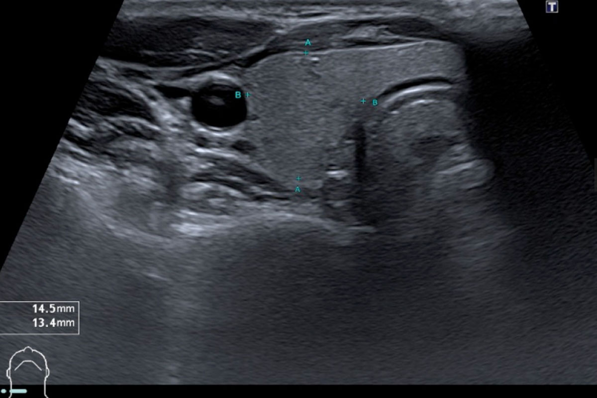 Monitoraufnahme einer Schilddrüsensonographie
